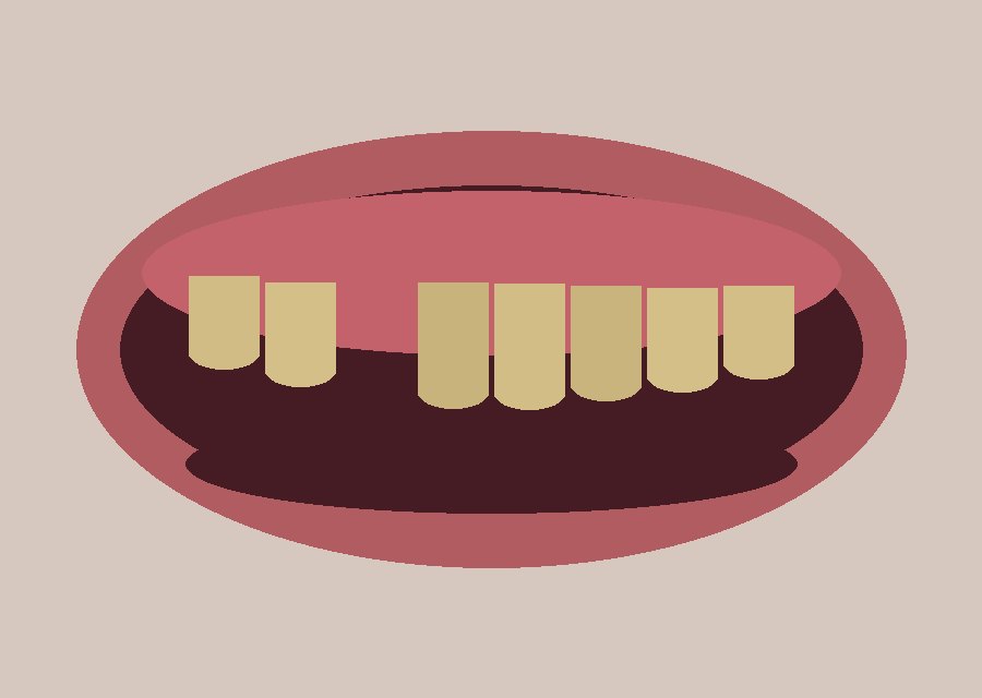 Upper jaw: 4 implants — Before
