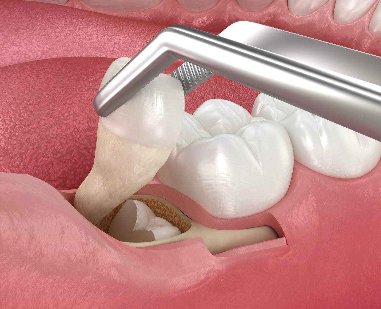 Oral surgery